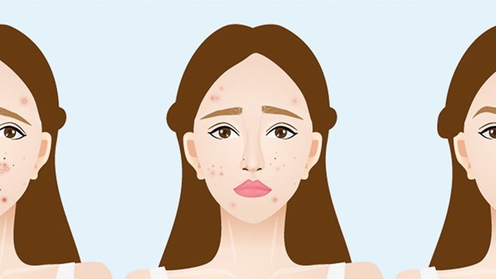 Creme aus Propolis, Teebaumöl und Aloe vera als  Alternative zu Erythromycin Creme für bessere Bekämpfung von Akne 