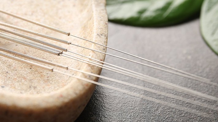 Carstens-Stiftung: Akupunktur als Behandlungsoption bei chronischem Prostatitis/Beckenschmerz-Syndrom