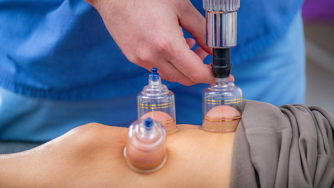 Wie wirkungsvoll ist Schröpfen bei Kniearthrose?