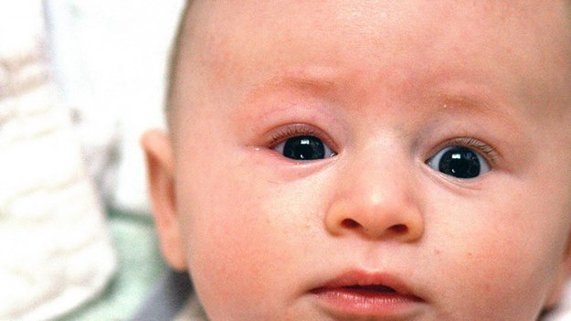 Carstens-Stiftung: Lidrandentzündung, Blepharitis, Parasiten 