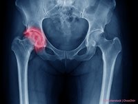 Carstens-Stiftung: Weniger Knorpelabbau auf natürlichem Wege?