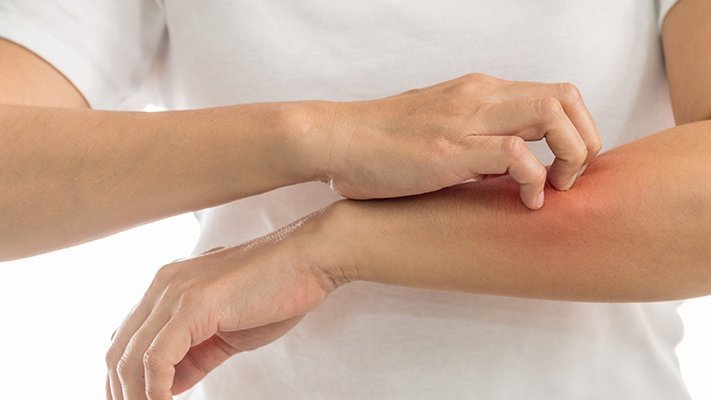 Carstens-Stiftung: Natürliche Behandlung der Schuppenflechte